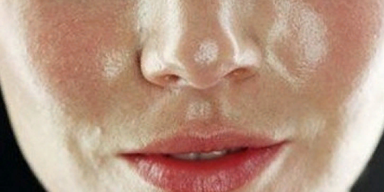 Жирная кожа