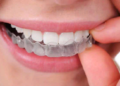 Исправление прикуса: способы и основные правила