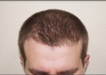 Технологический процесс пересадки волос и рекомендации