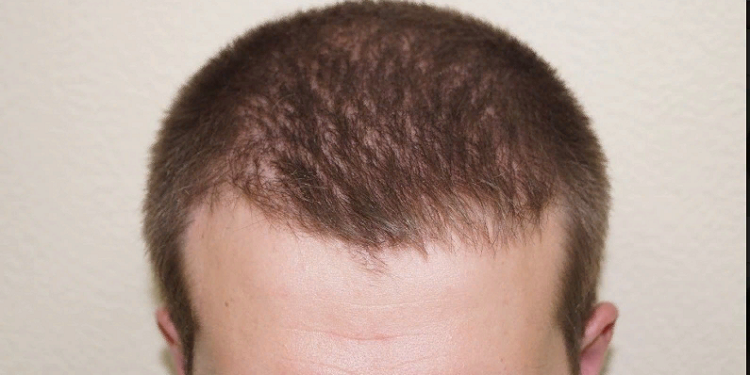 Технологический процесс пересадки волос и рекомендации