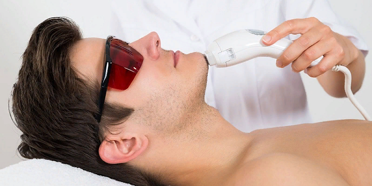 Правила лазерной эпиляции бороды мужчинам