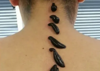 Особенности лечения живыми пиявками и противопоказания