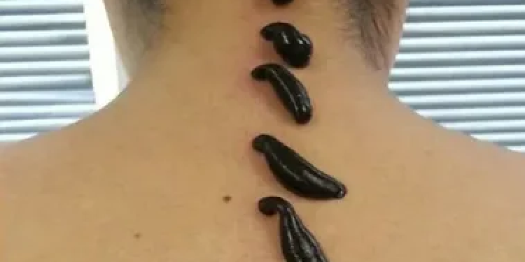 Особенности лечения живыми пиявками и противопоказания