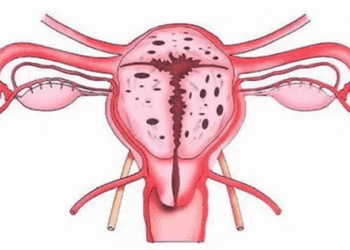 Какие последствия у эндометриоза и симптомы его проявления