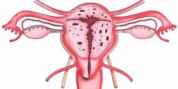 Какие последствия у эндометриоза и симптомы его проявления