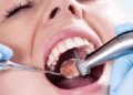 Лечение кариеса: современные техники, правила и советы