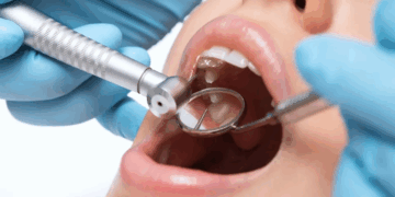 Лечение кариеса у взрослых: правила и особенности